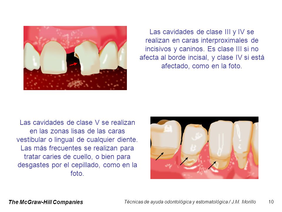Las cavidades de clase III y IV se realizan en caras interproximales de incisivos y caninos. Es clase III si no afecta al borde incisal, y clase IV si está afectado, como en la foto.
