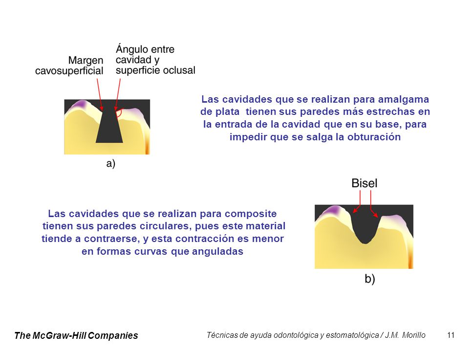 Las cavidades que se realizan para amalgama