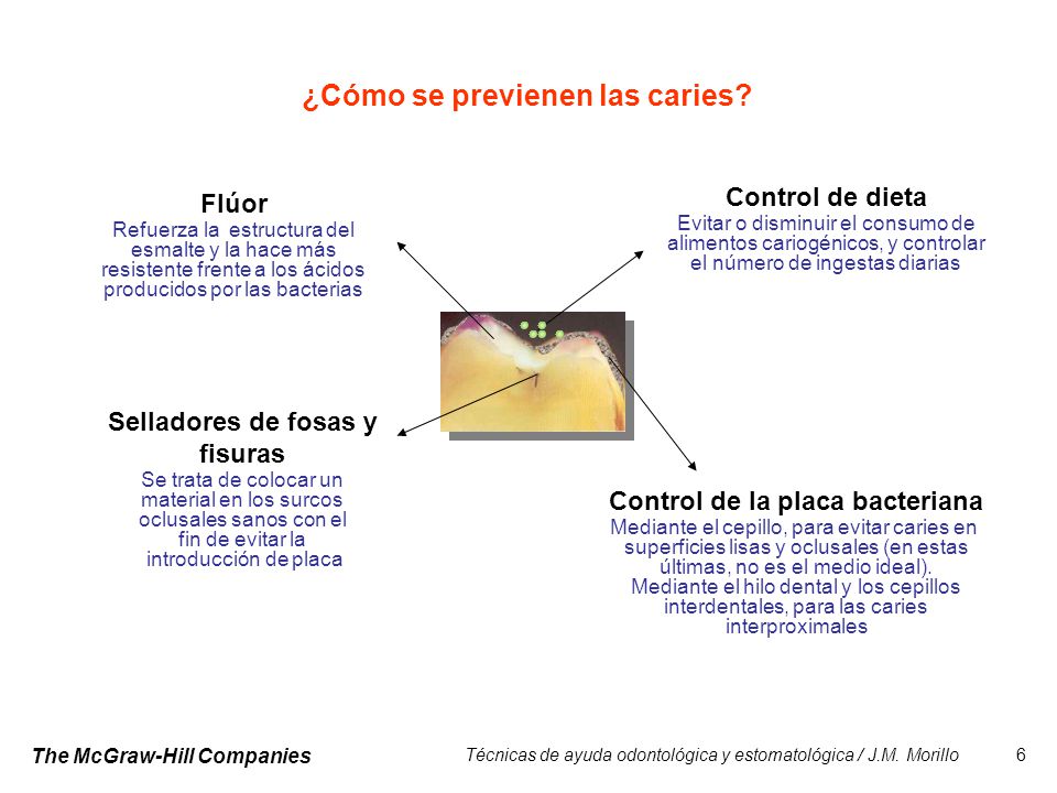 Selladores de fosas y fisuras Control de la placa bacteriana
