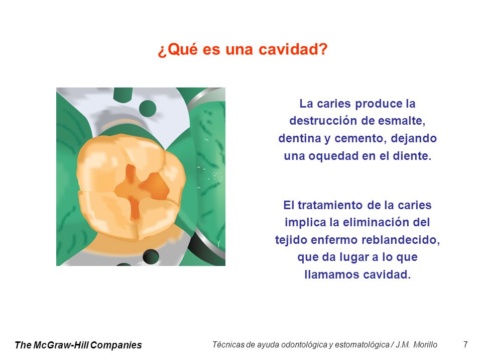 ¿Qué es una cavidad La caries produce la destrucción de esmalte, dentina y cemento, dejando una oquedad en el diente.