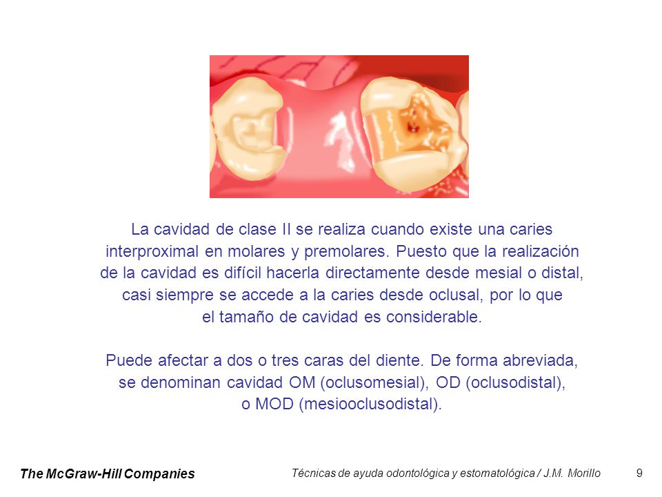 La cavidad de clase II se realiza cuando existe una caries