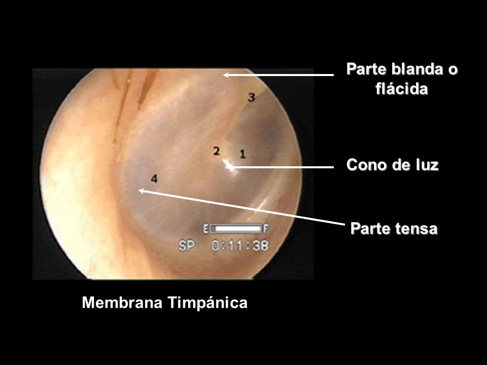 Parte blanda o flácida Cono de luz Parte tensa Membrana Timpánica