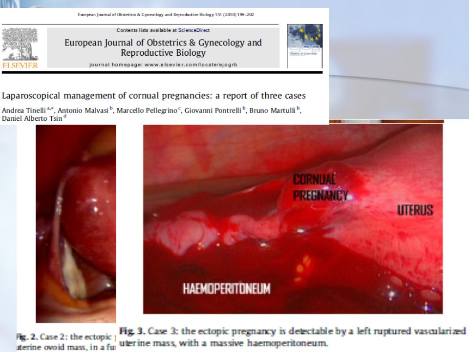 LPS con incisión (salpingostomia) y enucleación del ectópico cornual, coagulación y sutura uterina. Extracción con forceps de collins. Coagulación con p