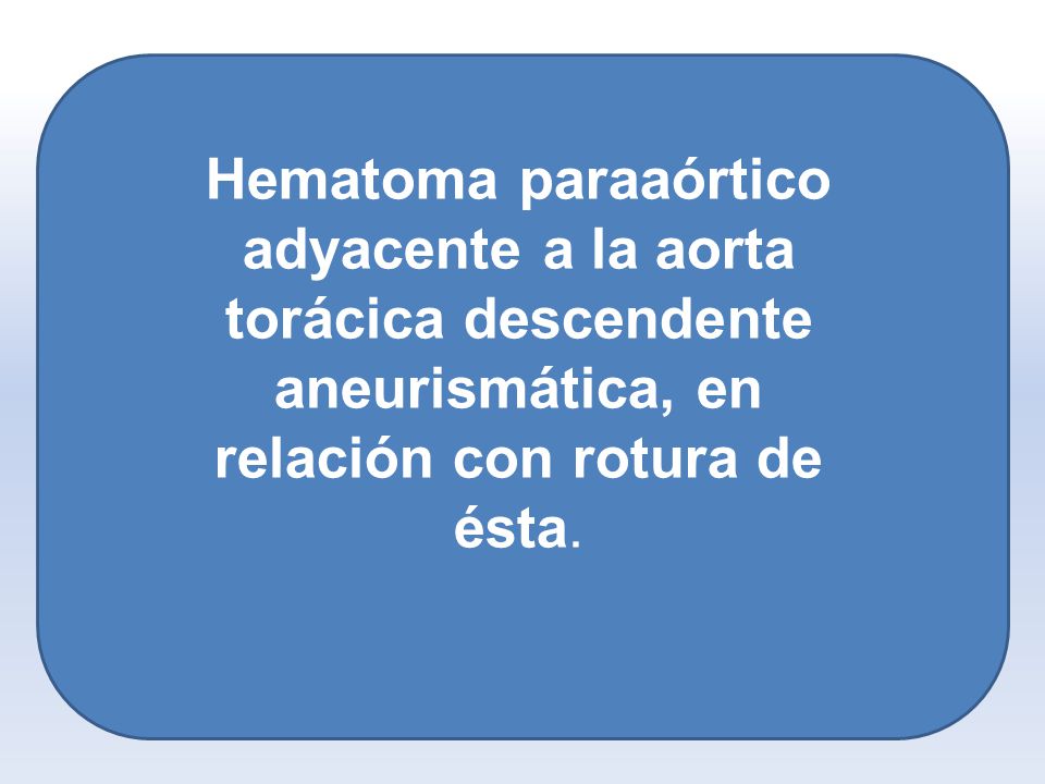 Hematoma paraaórtico adyacente a la aorta torácica descendente aneurismática, en relación con rotura de ésta.