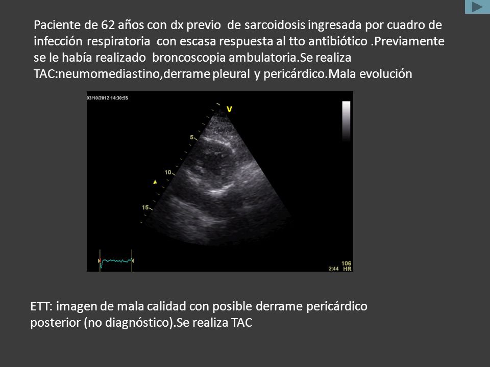 Paciente de 62 años con dx previo de sarcoidosis ingresada por cuadro de infección respiratoria con escasa respuesta al tto antibiótico .Previamente se le había realizado broncoscopia ambulatoria.Se realiza TAC:neumomediastino,derrame pleural y pericárdico.Mala evolución