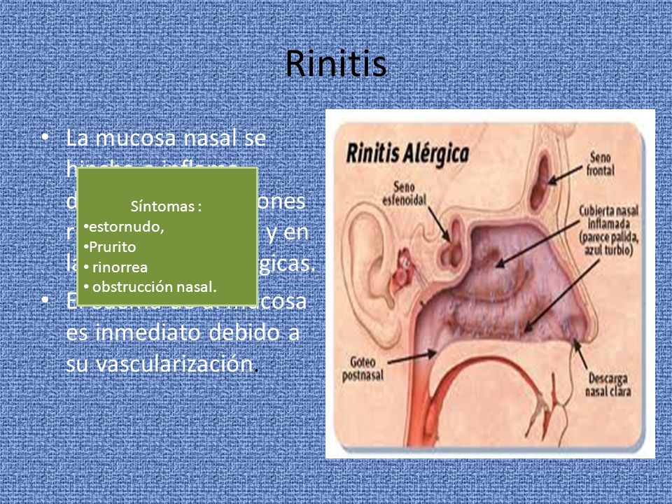Rinitis La mucosa nasal se hincha e inflama durante las infecciones respiratorias altas y en las reacciones alérgicas.