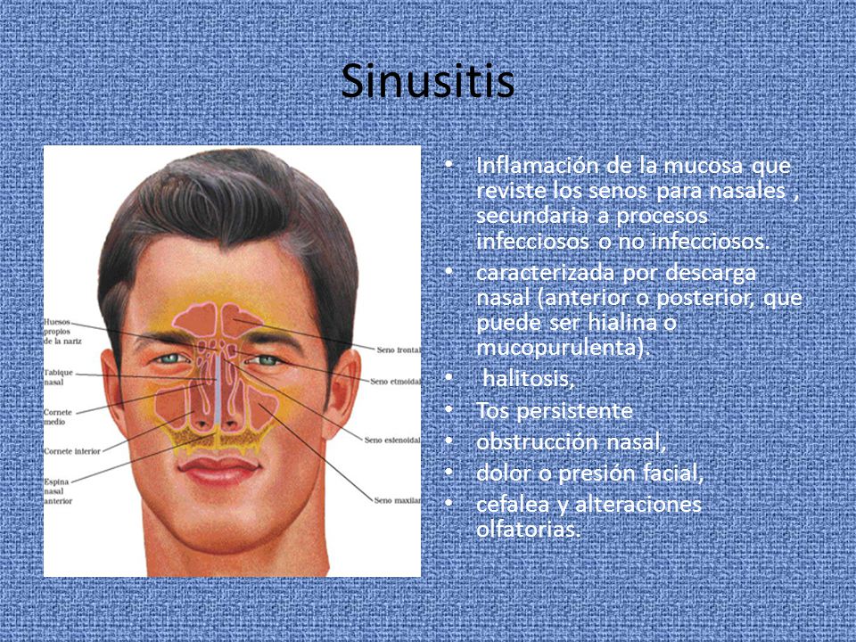 Sinusitis Inflamación de la mucosa que reviste los senos para nasales , secundaria a procesos infecciosos o no infecciosos.