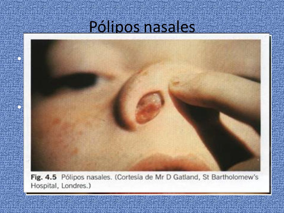 Pólipos nasales Los pólipos nasales son una condición inflamatoria de la mucosa de la nariz y senos paranasales.