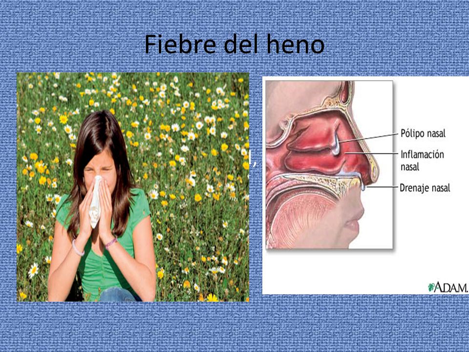 Fiebre del heno Forma de rinitis estacional, causada por alergia al polen
