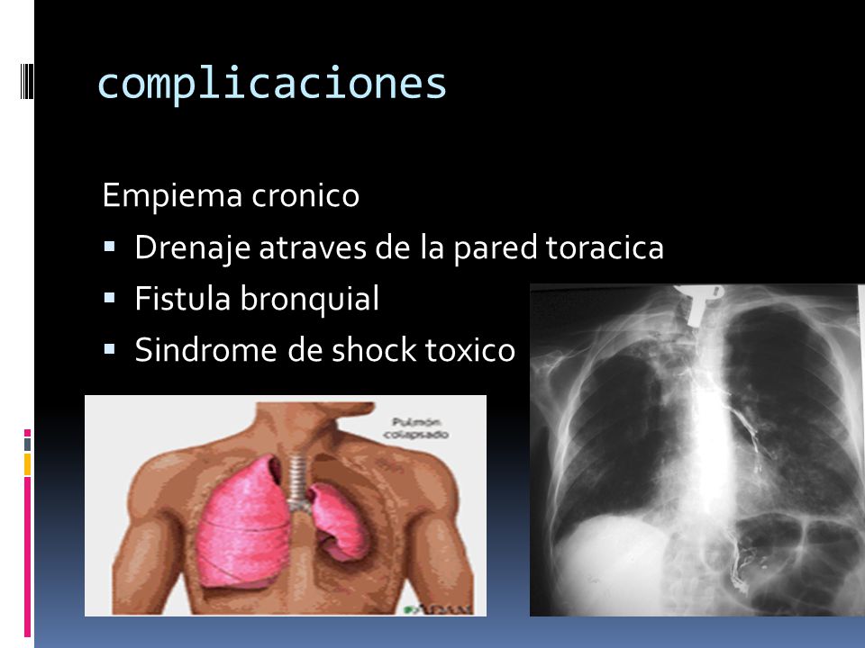 complicaciones Empiema cronico Drenaje atraves de la pared toracica