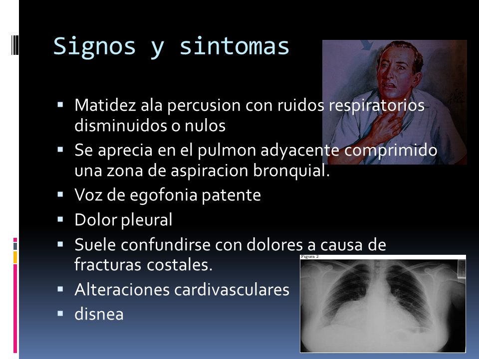 Signos y sintomas Matidez ala percusion con ruidos respiratorios disminuidos o nulos.