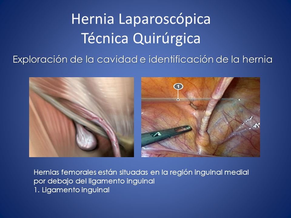 Exploración de la cavidad e identificación de la hernia