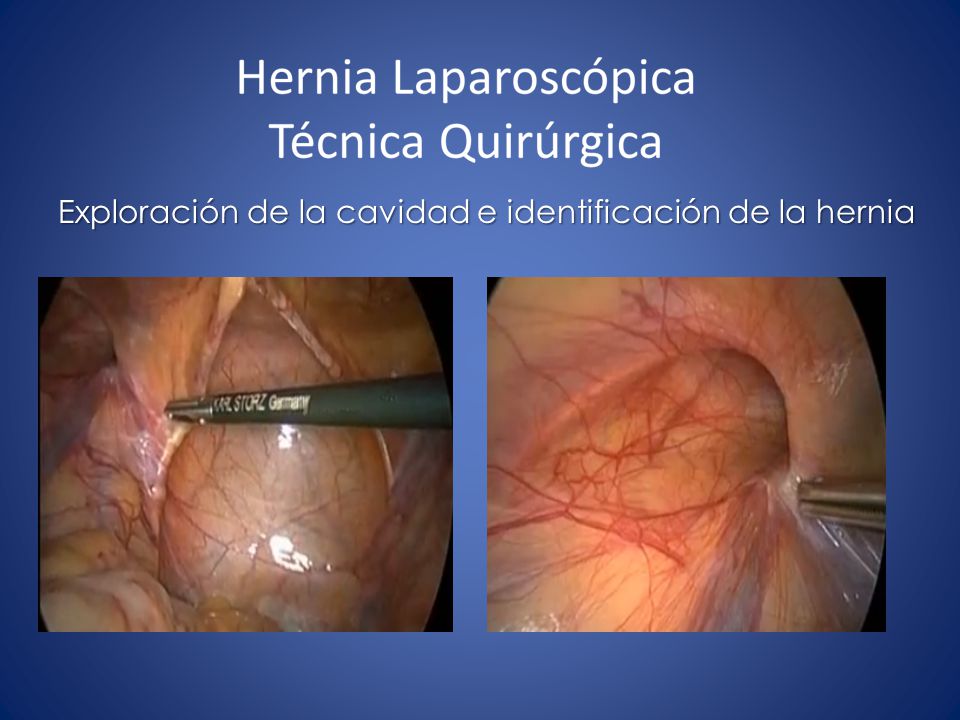 Exploración de la cavidad e identificación de la hernia