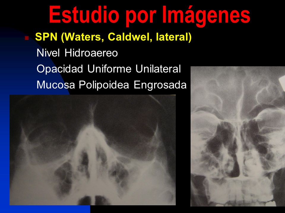 Estudio por Imágenes SPN (Waters, Caldwel, lateral) Nivel Hidroaereo
