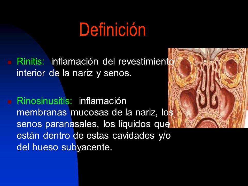 Definición Rinitis: inflamación del revestimiento interior de la nariz y senos.