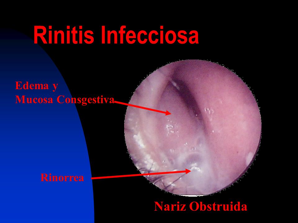 Rinitis Infecciosa Edema y Mucosa Consgestiva Rinorrea Nariz Obstruida
