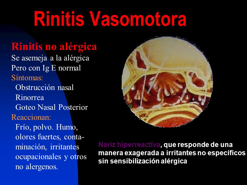 Rinitis Vasomotora Rinitis no alérgica Se asemeja a la alérgica