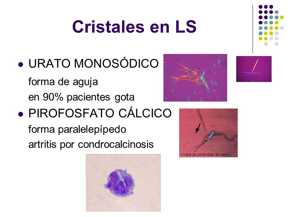 Cristales en LS URATO MONOSÓDICO forma de aguja PIROFOSFATO CÁLCICO