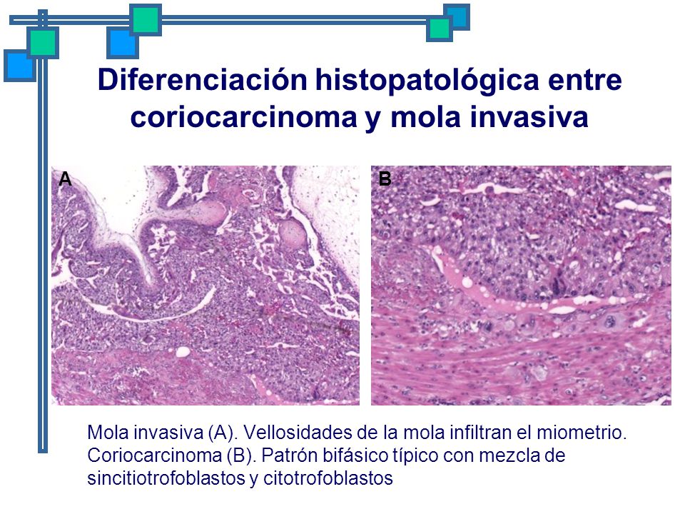 Diferenciación histopatológica entre coriocarcinoma y mola invasiva