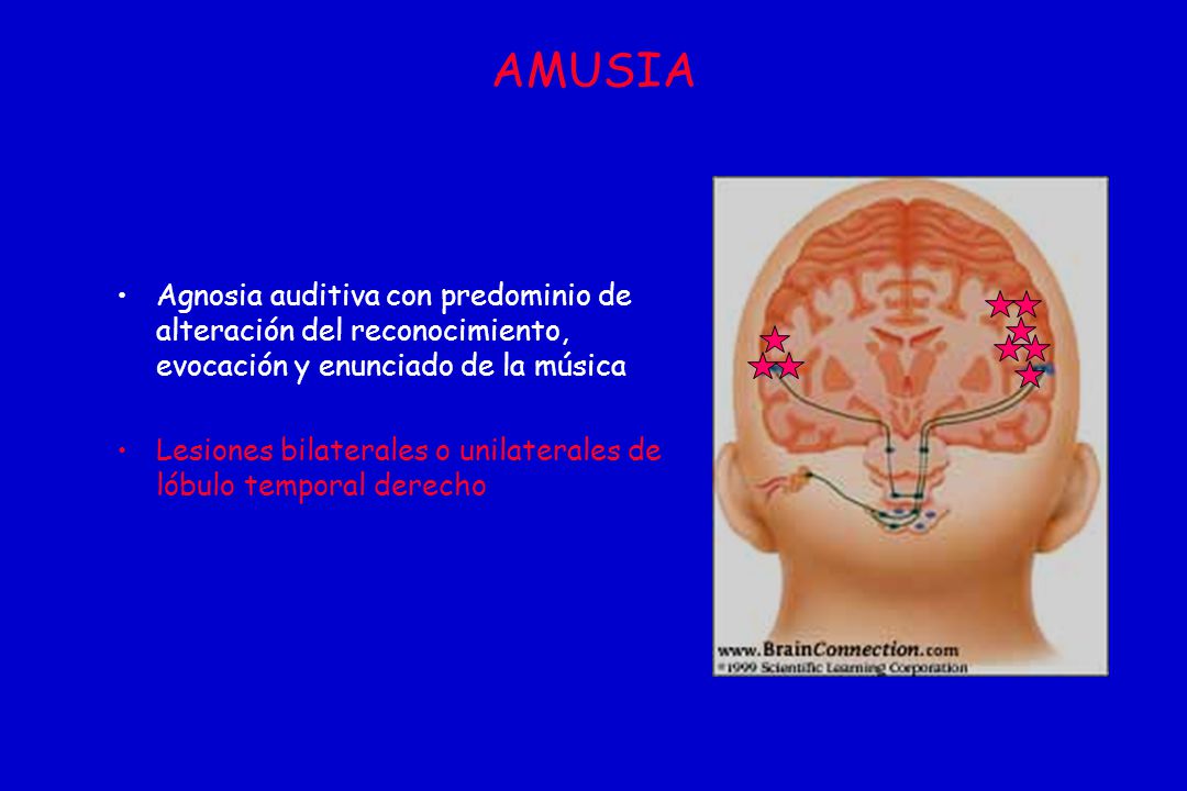 AMUSIA Agnosia auditiva con predominio de alteración del reconocimiento, evocación y enunciado de la música.