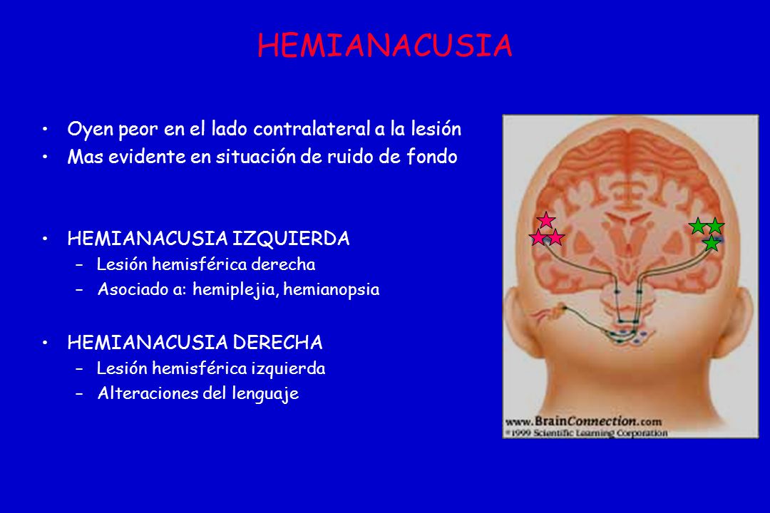 HEMIANACUSIA Oyen peor en el lado contralateral a la lesión