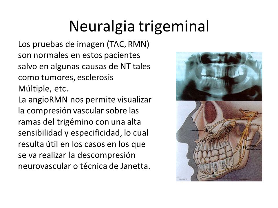 Neuralgia trigeminal Los pruebas de imagen (TAC, RMN) son normales en estos pacientes salvo en algunas causas de NT tales como tumores, esclerosis.