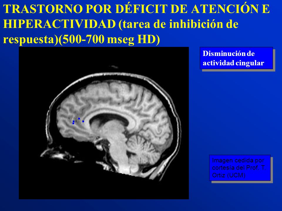 TRASTORNO POR DÉFICIT DE ATENCIÓN E HIPERACTIVIDAD (tarea de inhibición de respuesta)( mseg HD)