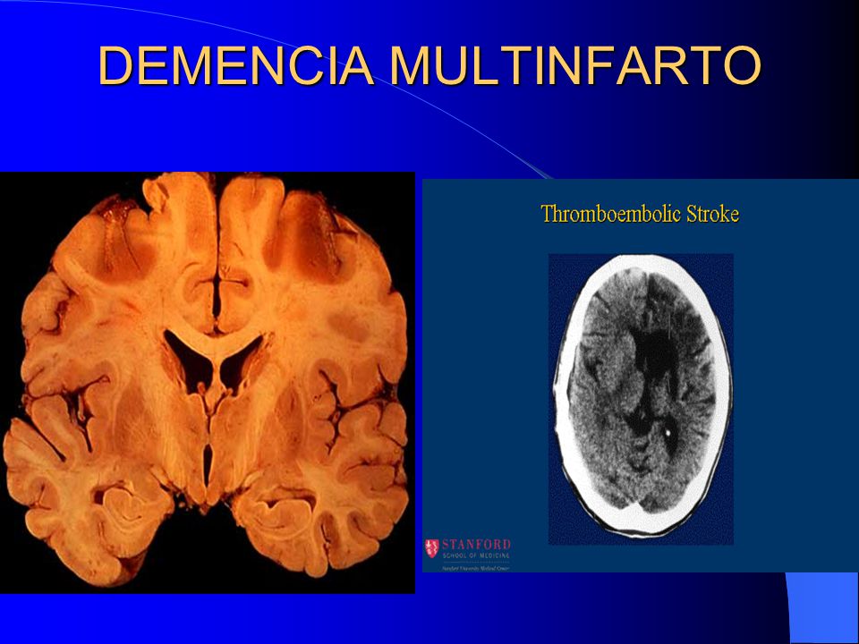DEMENCIA MULTINFARTO