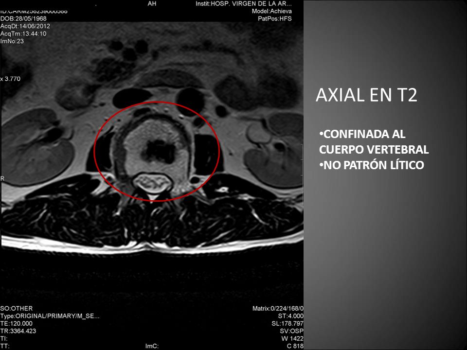 AXIAL EN T2 CONFINADA AL CUERPO VERTEBRAL NO PATRÓN LÍTICO