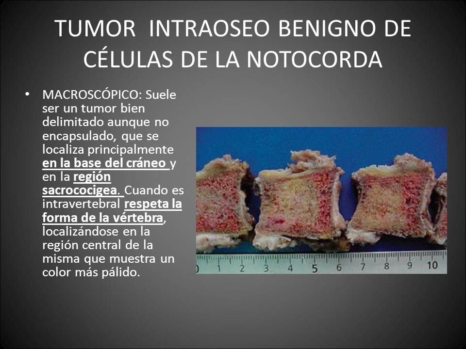 TUMOR INTRAOSEO BENIGNO DE CÉLULAS DE LA NOTOCORDA