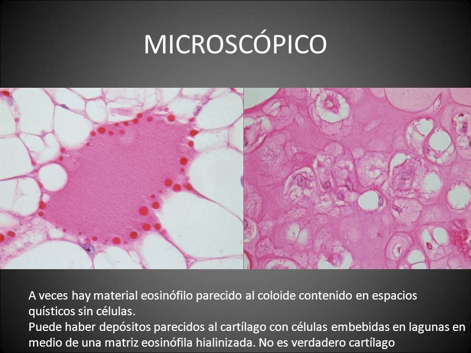 MICROSCÓPICO A veces hay material eosinófilo parecido al coloide contenido en espacios quísticos sin células.