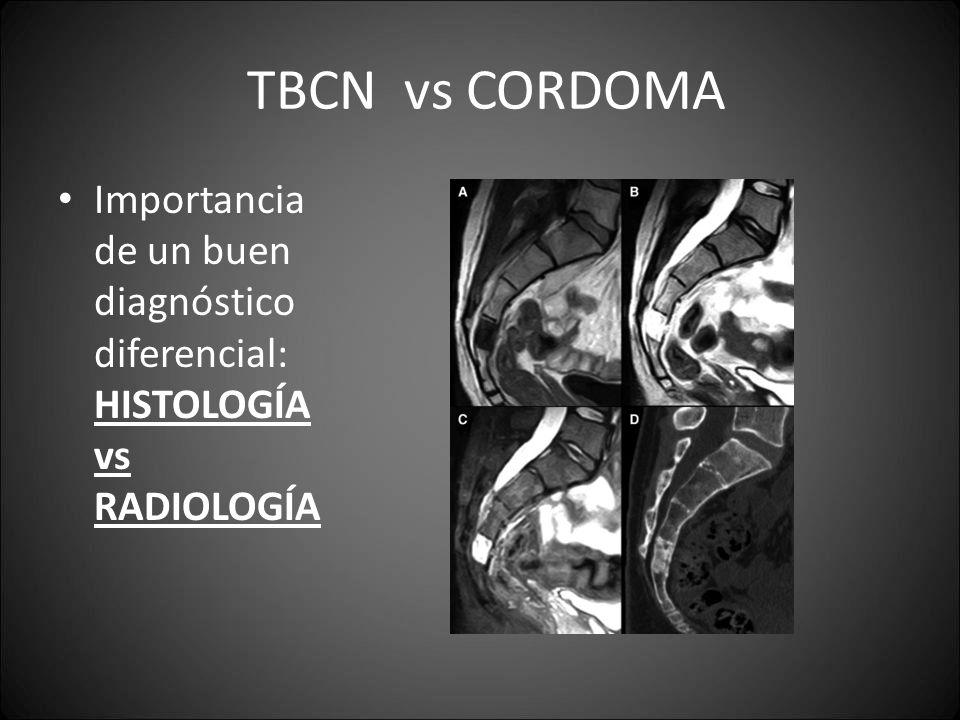 TBCN vs CORDOMA Importancia de un buen diagnóstico diferencial: HISTOLOGÍA vs RADIOLOGÍA.