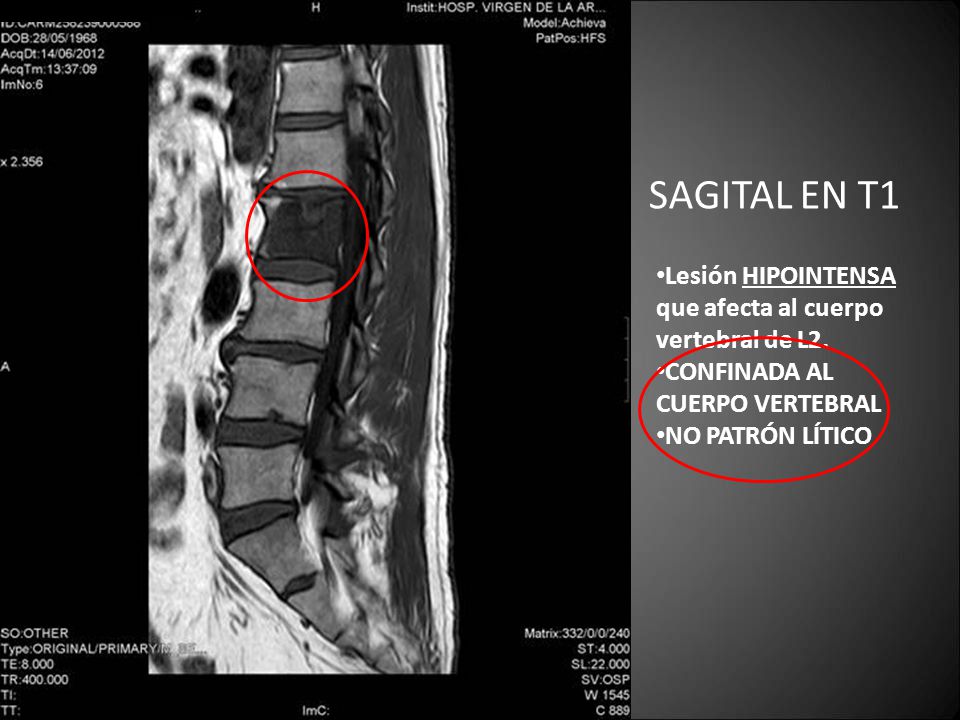SAGITAL EN T1 Lesión HIPOINTENSA que afecta al cuerpo vertebral de L2.
