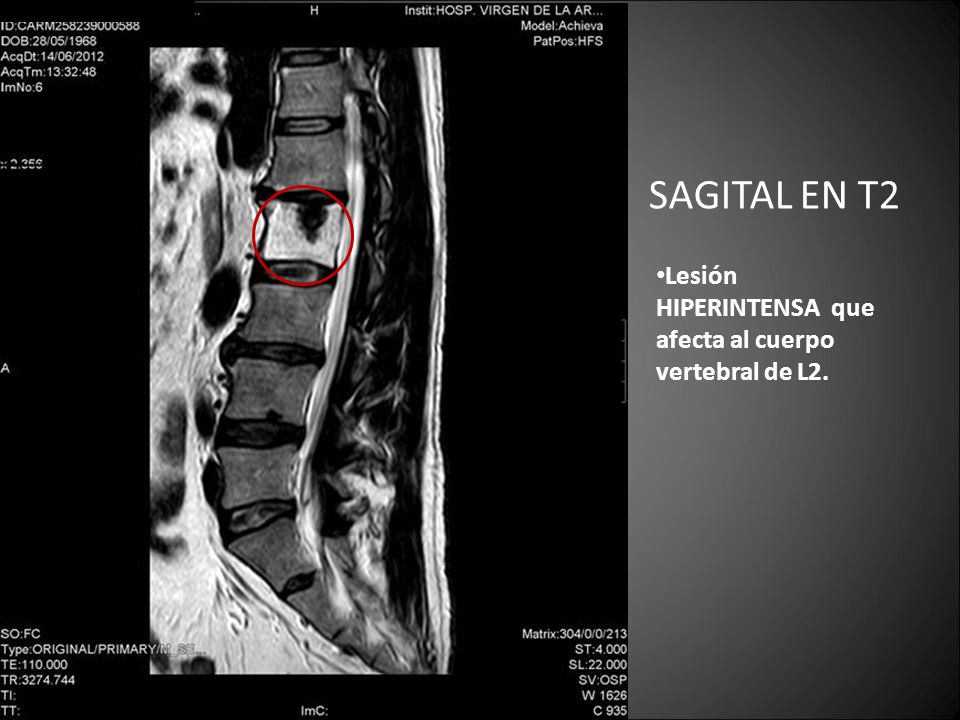 SAGITAL EN T2 Lesión HIPERINTENSA que afecta al cuerpo vertebral de L2.