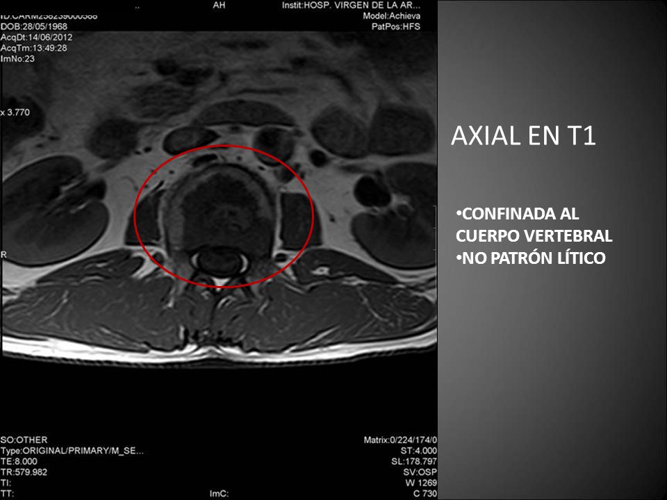 AXIAL EN T1 CONFINADA AL CUERPO VERTEBRAL NO PATRÓN LÍTICO