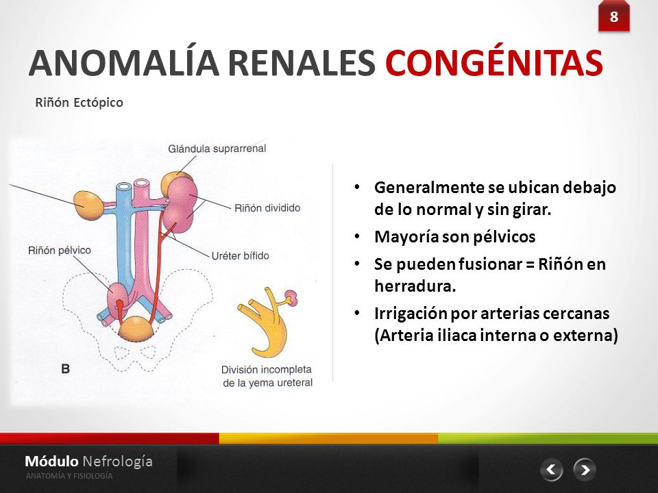ANOMALÍA RENALES CONGÉNITAS