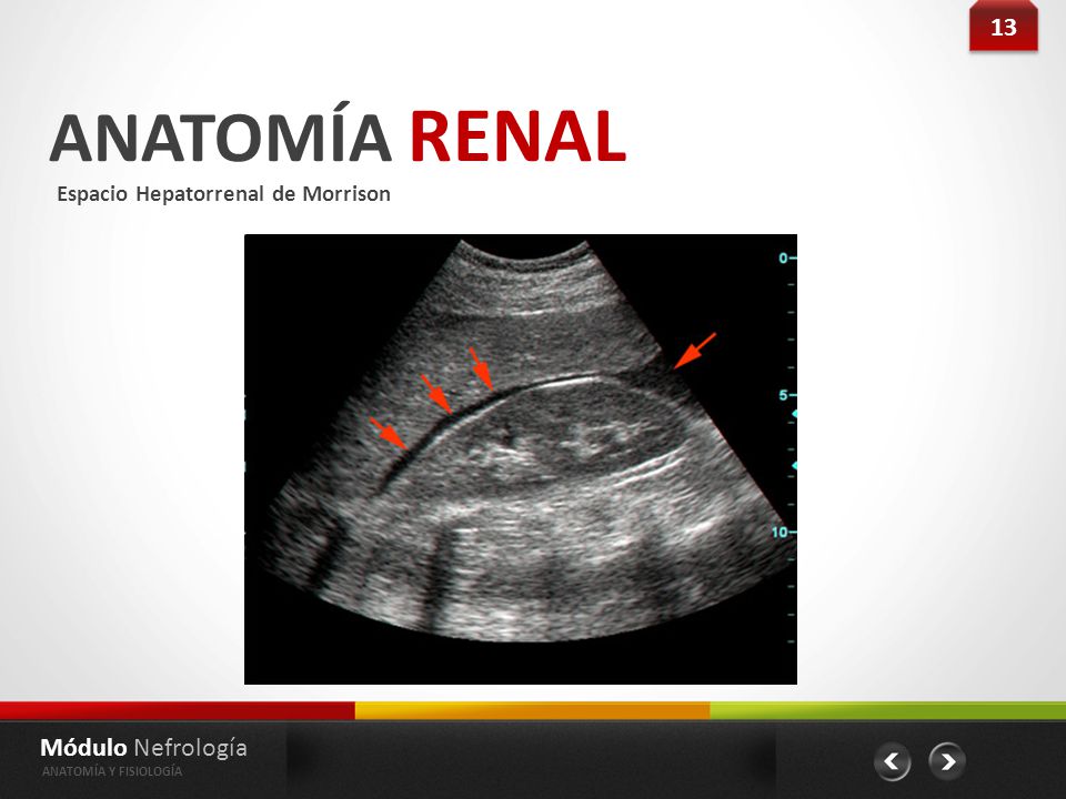 ANATOMÍA RENAL 13 Módulo Nefrología Espacio Hepatorrenal de Morrison