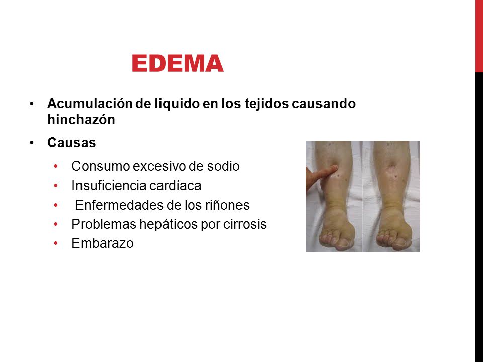 EDEma Acumulación de liquido en los tejidos causando hinchazón Causas