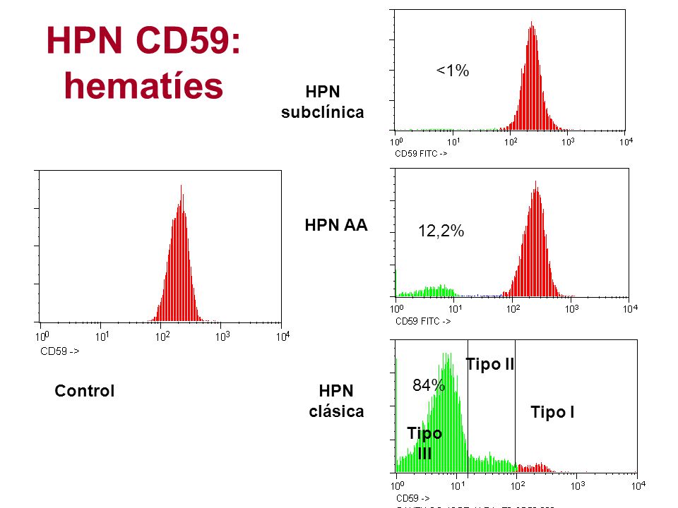 HPN CD59: hematíes <1% HPN subclínica HPN AA 12,2% Tipo II 84%