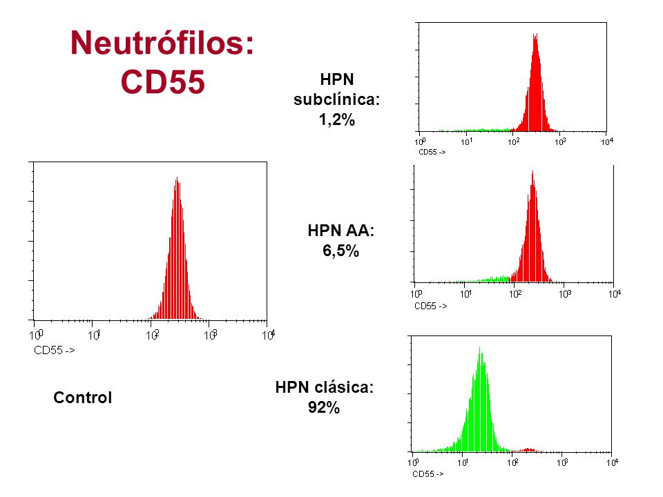 Neutrófilos: CD55 HPN subclínica: 1,2% HPN AA: 6,5% HPN clásica: 92%