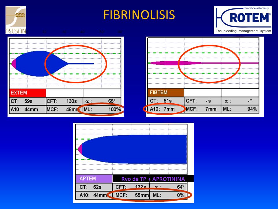 FIBRINOLISIS 10` 20` 30` 40` 50` 60` Rvo de TP + APROTININA