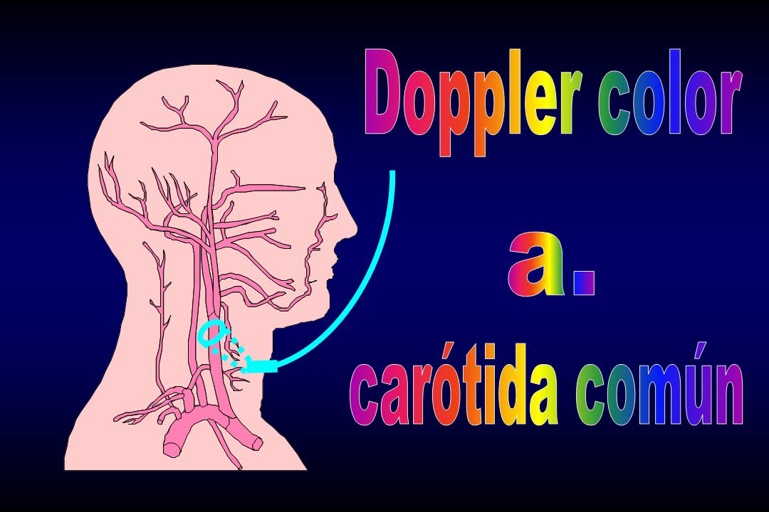 Doppler color a. carótida común