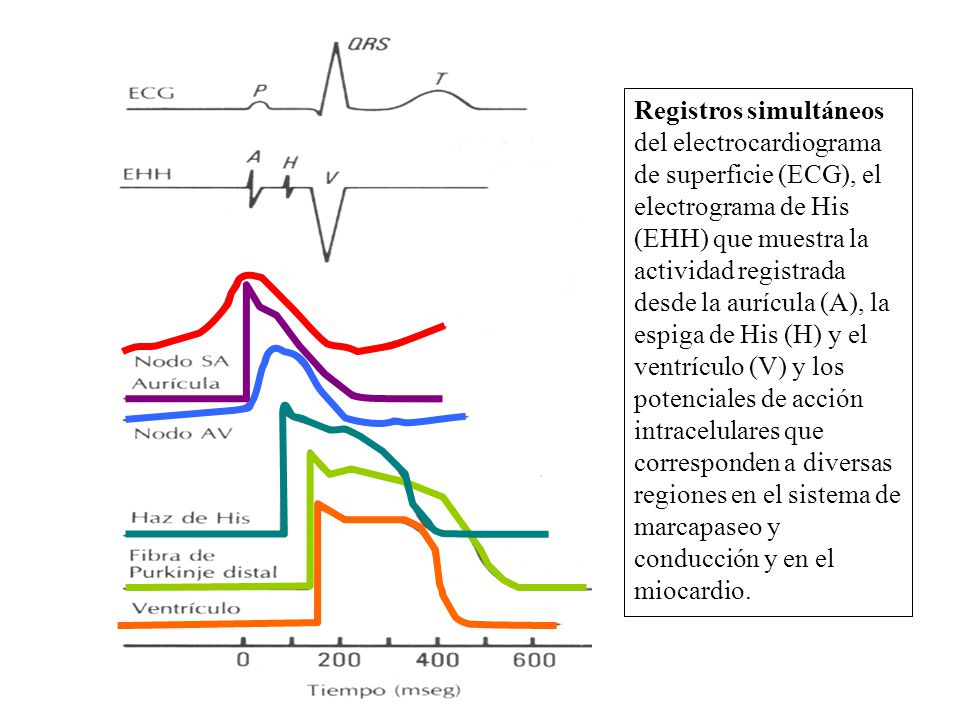 Registros simultáneos del electrocardiograma de superficie (ECG), el electrograma de His (EHH) que muestra la actividad registrada desde la aurícula (A), la espiga de His (H) y el ventrículo (V) y los potenciales de acción intracelulares que corresponden a diversas regiones en el sistema de marcapaseo y conducción y en el miocardio.