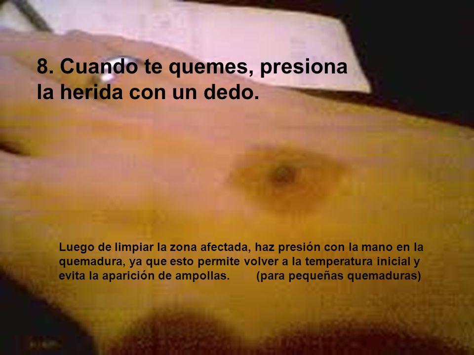 8. Cuando te quemes, presiona la herida con un dedo.