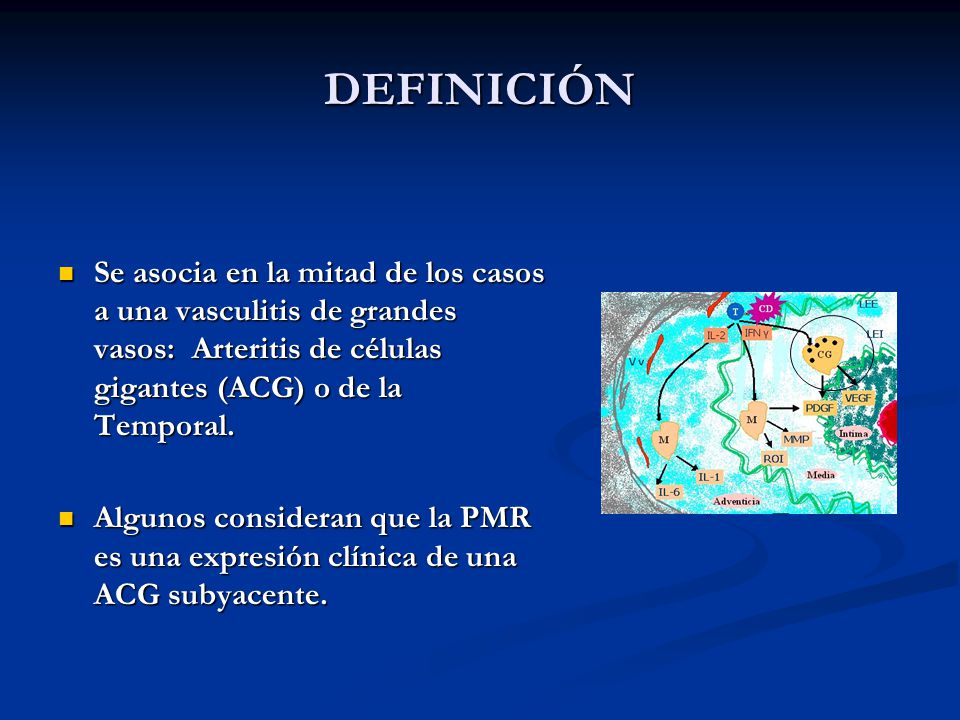 DEFINICIÓN Se asocia en la mitad de los casos a una vasculitis de grandes vasos: Arteritis de células gigantes (ACG) o de la Temporal.