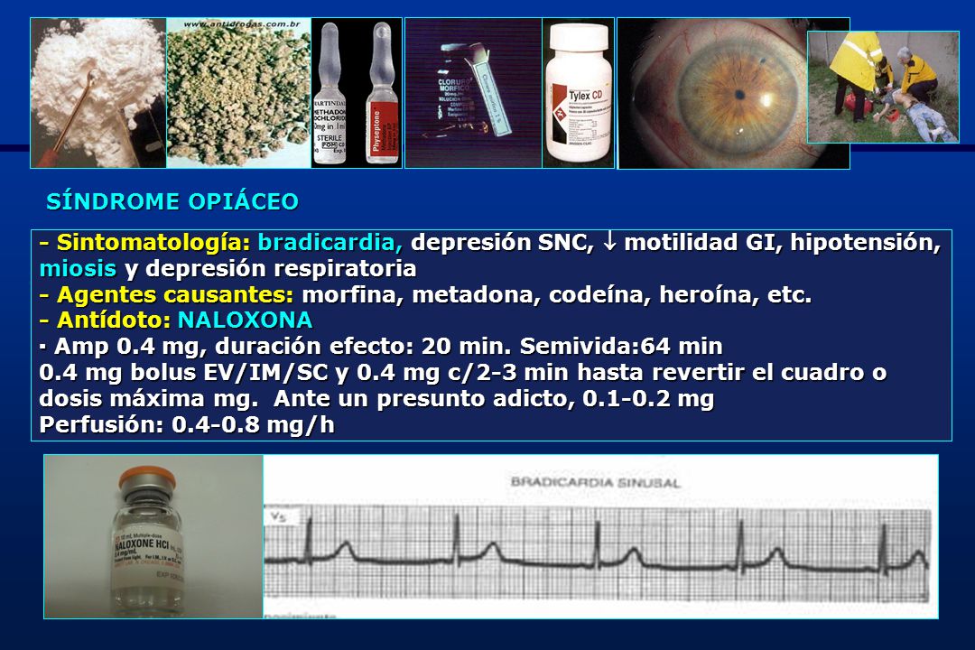 SÍNDROME OPIÁCEO - Sintomatología: bradicardia, depresión SNC,  motilidad GI, hipotensión, miosis y depresión respiratoria.