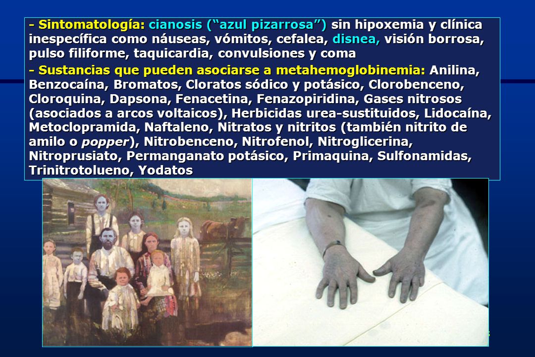 - Sintomatología: cianosis ( azul pizarrosa ) sin hipoxemia y clínica