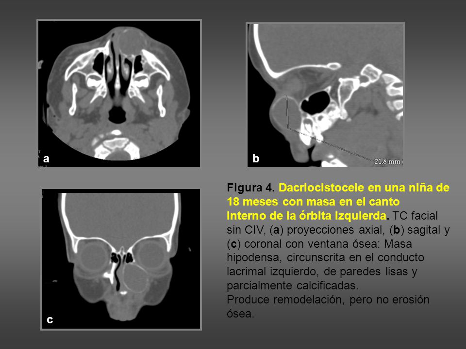 a b. Figura 4. Dacriocistocele en una niña de 18 meses con masa en el canto.