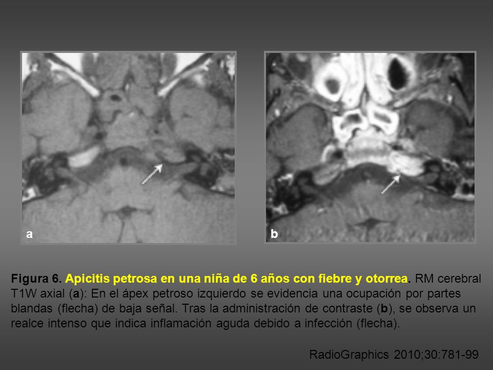 a b. Figura 6. Apicitis petrosa en una niña de 6 años con fiebre y otorrea. RM cerebral.