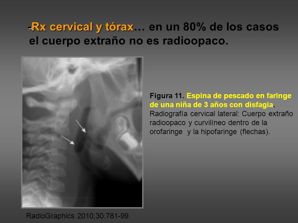 -Rx cervical y tórax… en un 80% de los casos el cuerpo extraño no es radioopaco.